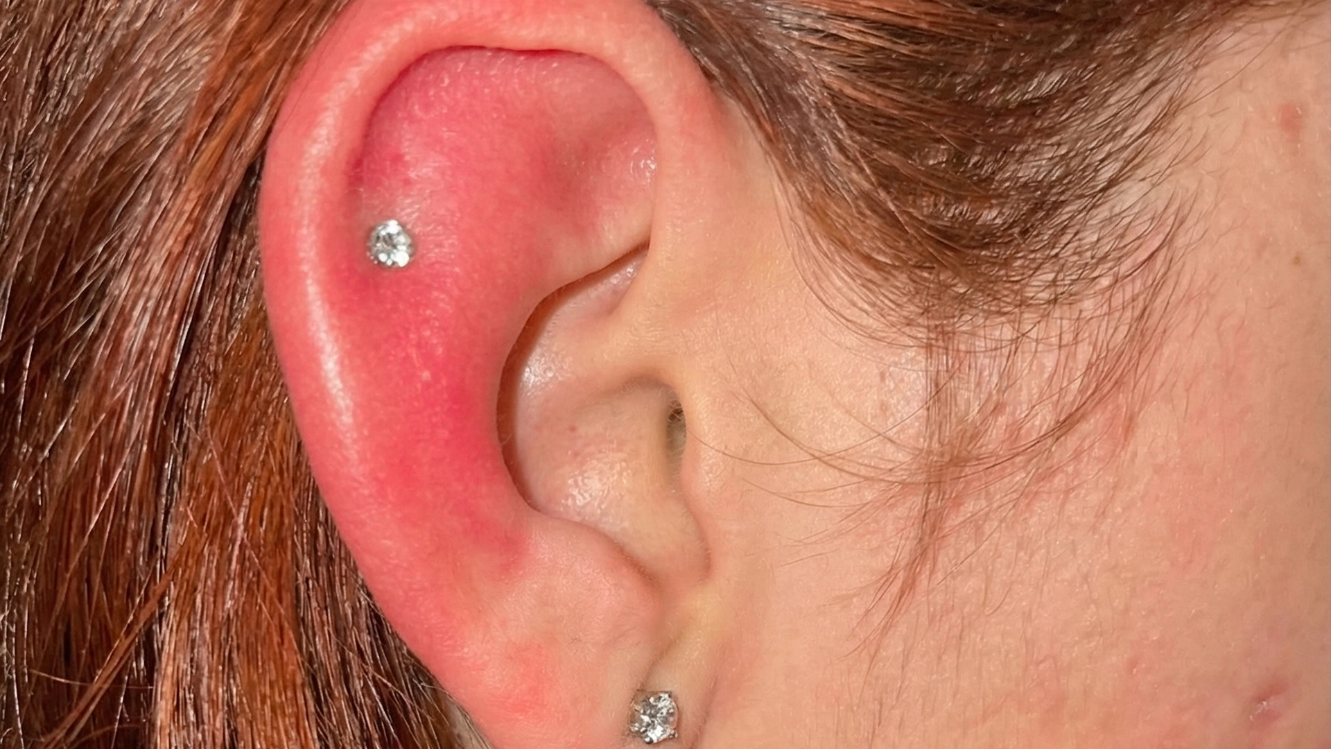 Porc piercing gyulladás fülbelövés után (auricular chondritis)
