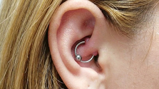 Vadhús (piercing bump) vagy granulóma daith piercing mellett