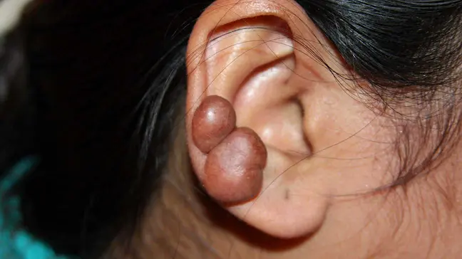 Valódi keloidos hegesedés (vadhús) fül piercing után